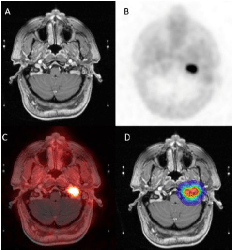 MRI - PET-CT